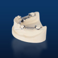 Dental Cast Partial Framework